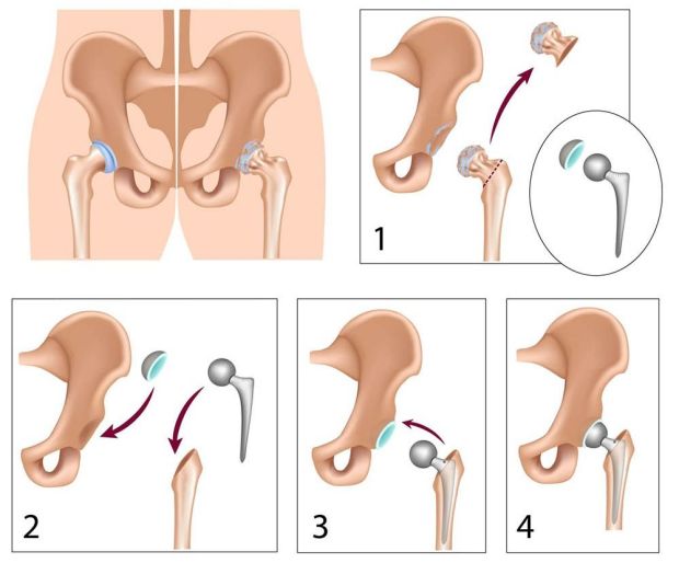 An illustration of how a hip joint is replaced. During total hip replacement surgery, the damaged bone and cartilage are removed from the hip joint. These are replaced with metal or plastic parts. (Courtesy of Australian Government Department of Health and Aged Care)